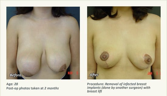 Reconstructive Surgery in Plano, TX - Patient 22