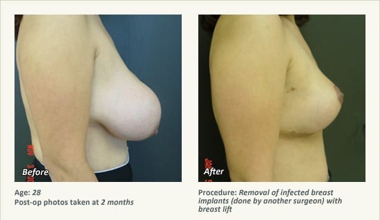 Reconstructive Surgery in Plano, TX - Patient 21