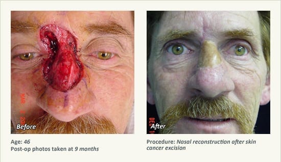 Reconstructive Surgery in Plano, TX - Patient 23