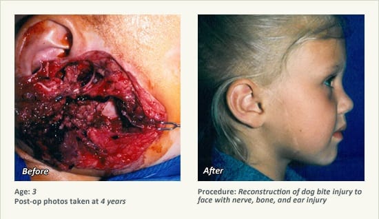 Reconstructive Surgery in Plano, TX - Patient 25