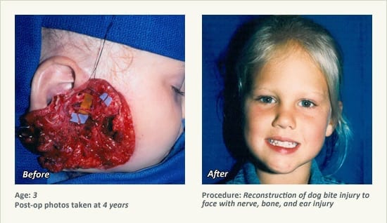 Reconstructive Surgery in Plano, TX - Patient 26