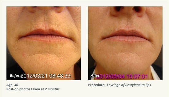 Restylane® & JUVÉDERM® Gel Injectable Fillers In Plano, TX - Patient 23