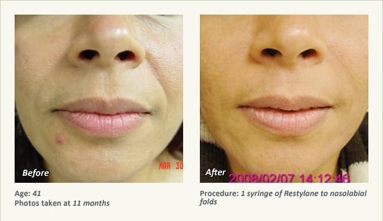 Restylane® & JUVÉDERM® Gel Injectable Fillers In Plano, TX - Patient 24
