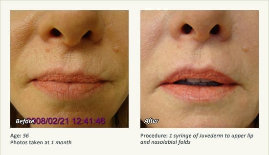 Restylane® & JUVÉDERM® Gel Injectable Fillers In Plano, TX - Patient 25
