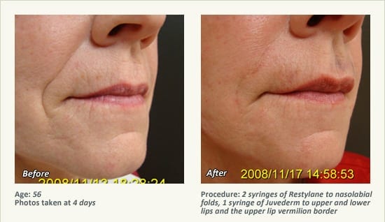 Restylane® & JUVÉDERM® Gel Injectable Fillers In Plano, TX - Patient 27