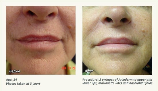 Restylane® & JUVÉDERM® Gel Injectable Fillers In Plano, TX - Patient 18