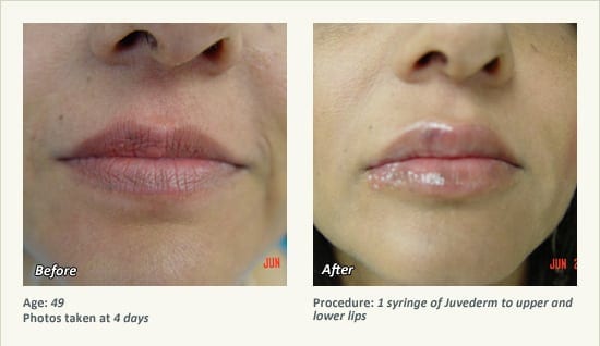 Restylane® & JUVÉDERM® Gel Injectable Fillers In Plano, TX - Patient 29