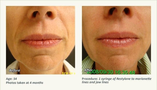 Restylane® & JUVÉDERM® Gel Injectable Fillers In Plano, TX - Patient 30