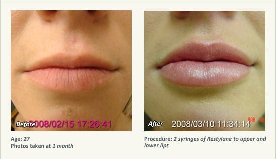 Restylane® & JUVÉDERM® Gel Injectable Fillers In Plano, TX - Patient 14