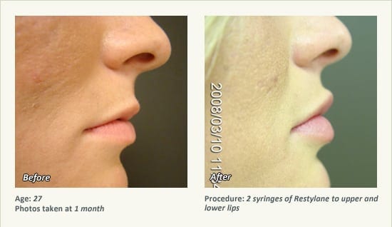Restylane® & JUVÉDERM® Gel Injectable Fillers In Plano, TX - Patient 15
