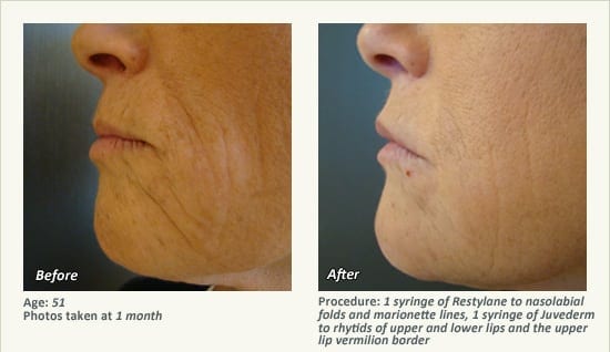 Restylane® & JUVÉDERM® Gel Injectable Fillers In Plano, TX - Patient 32
