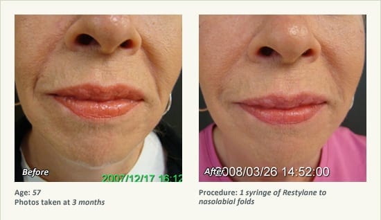 Restylane® & JUVÉDERM® Gel Injectable Fillers In Plano, TX - Patient 33