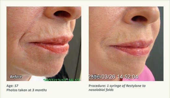 Restylane® & JUVÉDERM® Gel Injectable Fillers In Plano, TX - Patient 34