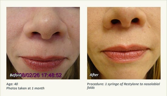 Restylane® & JUVÉDERM® Gel Injectable Fillers In Plano, TX - Patient 36