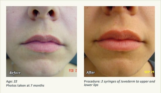 Restylane® & JUVÉDERM® Gel Injectable Fillers In Plano, TX - Patient 37
