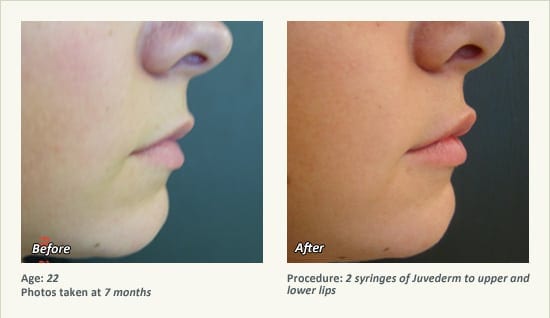 Restylane® & JUVÉDERM® Gel Injectable Fillers In Plano, TX - Patient 38