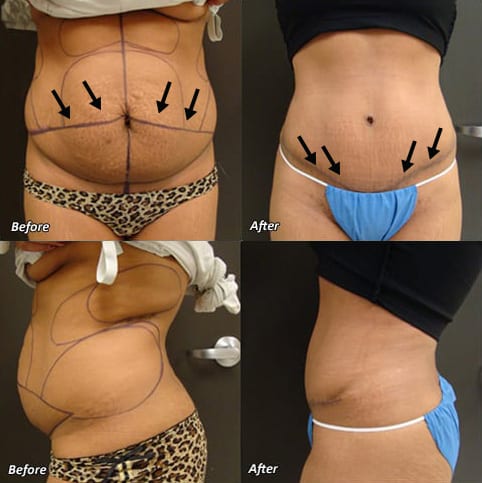 Before & After Tummy Tuck | Ronald M. Friedman, M.D.