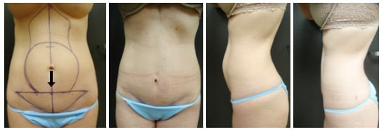 Umbilical float results