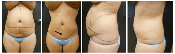 Before & After Liposuction | Ronald M. Friedman, M.D."