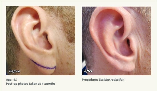 Earlobe Surgery in Plano, TX - Patient 63