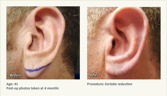 Earlobe Surgery in Plano, TX - Patient 64