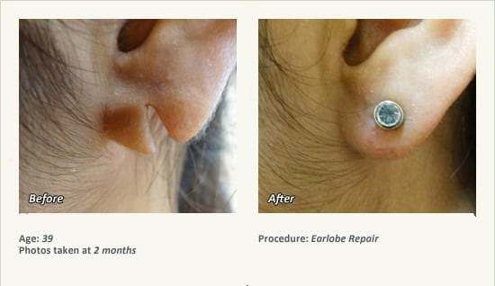 Earlobe Surgery in Plano, TX - Patient 45