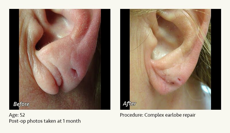 Earlobe Surgery in Plano, TX - Patient 38