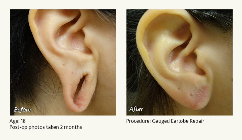 Earlobe Surgery in Plano, TX - Patient 49