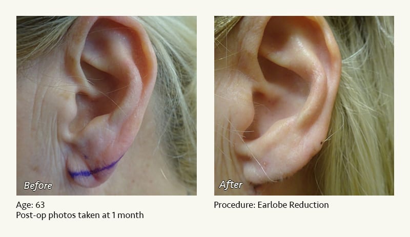 Earlobe Surgery in Plano, TX - Patient 51