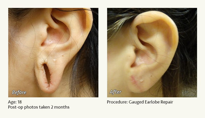 Earlobe Surgery in Plano, TX - Patient 48