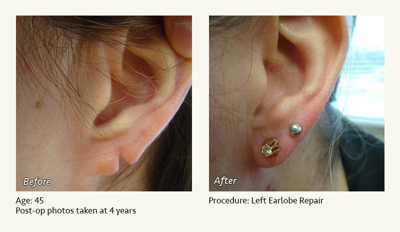 Earlobe Surgery in Plano, TX - Patient 52