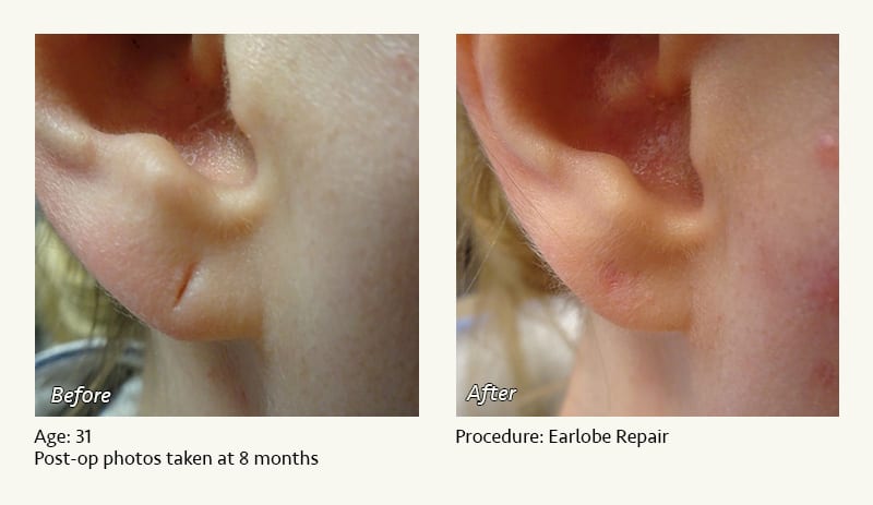 Earlobe Surgery in Plano, TX - Patient 47