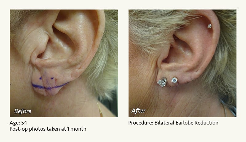 Earlobe Surgery in Plano, TX - Patient 54