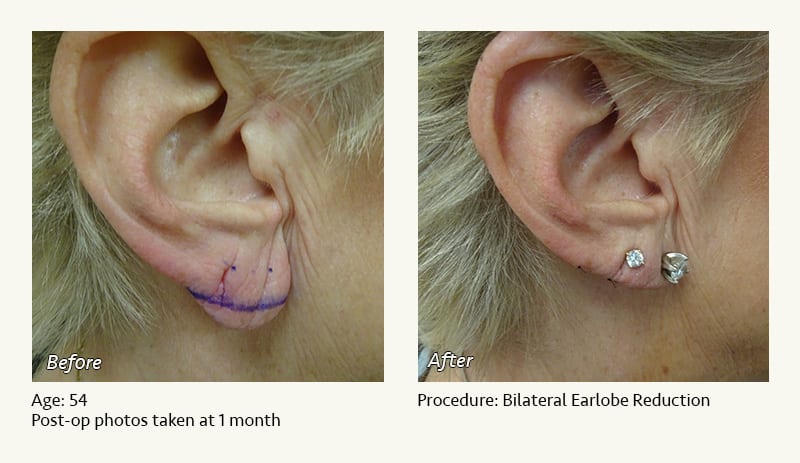 Earlobe Surgery in Plano, TX - Patient 55