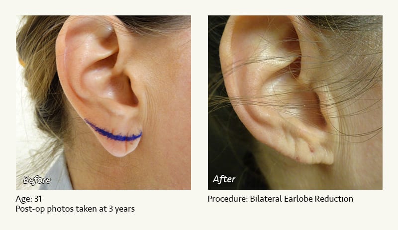 Earlobe Surgery in Plano, TX - Patient 57