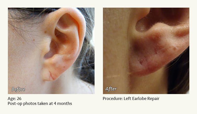 Earlobe Surgery in Plano, TX - Patient 58