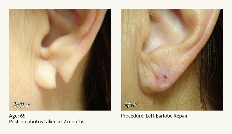 Earlobe Surgery in Plano, TX - Patient 59
