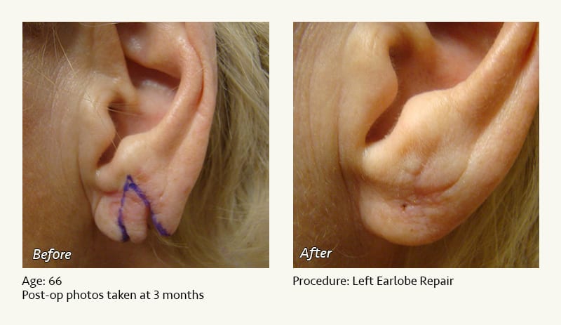 Earlobe Surgery in Plano, TX - Patient 60