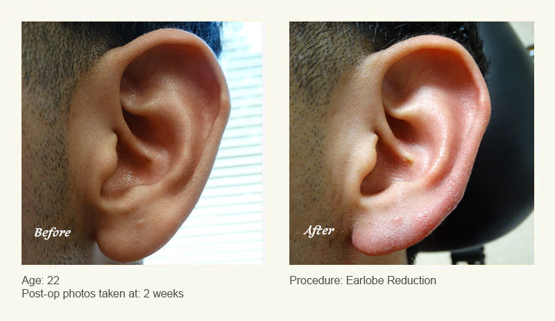 Earlobe Surgery in Plano, TX - Patient 1