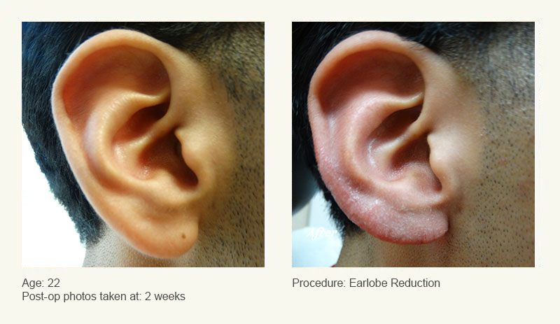 Earlobe Surgery in Plano, TX - Patient 2
