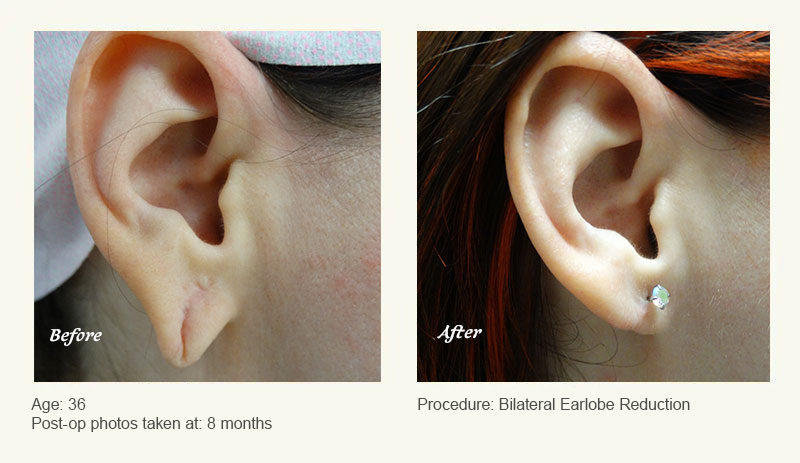 Earlobe Surgery in Plano, TX - Patient 1