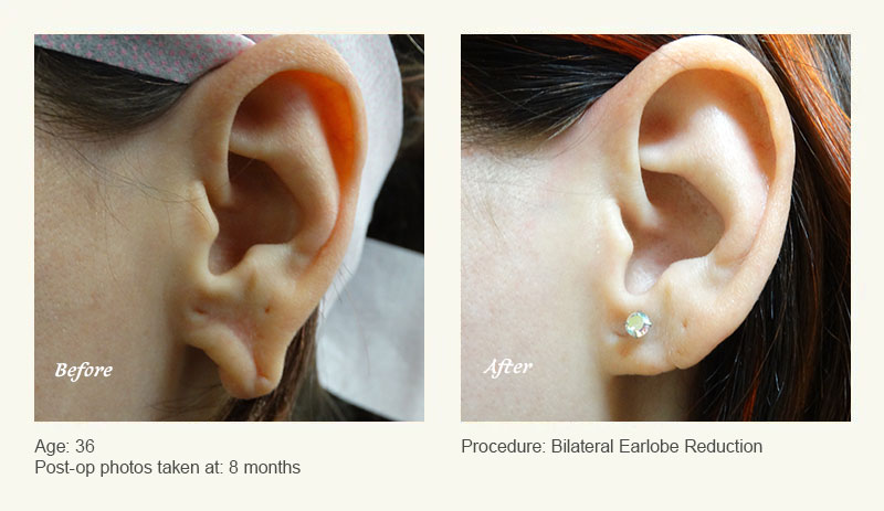 Earlobe Surgery in Plano, TX - Patient 2