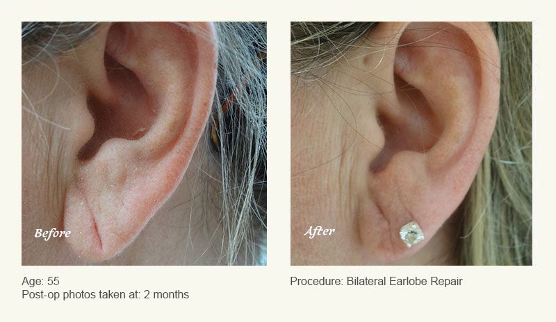 Earlobe Surgery in Plano, TX - Patient 3