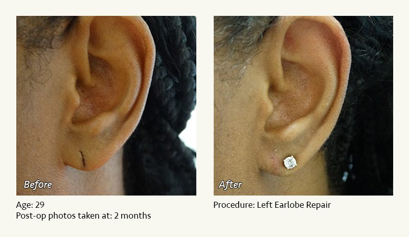 Earlobe Surgery in Plano, TX - Patient 5