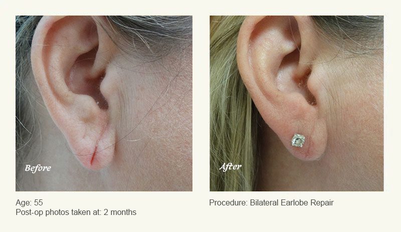 Earlobe Surgery in Plano, TX - Patient 4