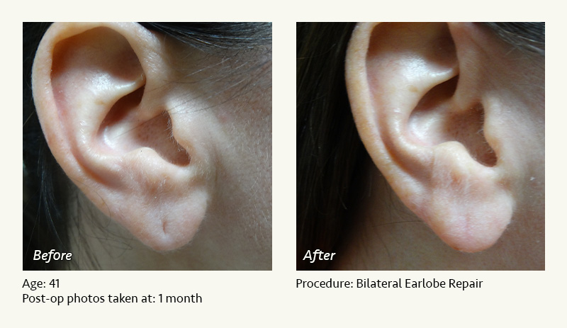 Earlobe Surgery in Plano, TX - Patient 4