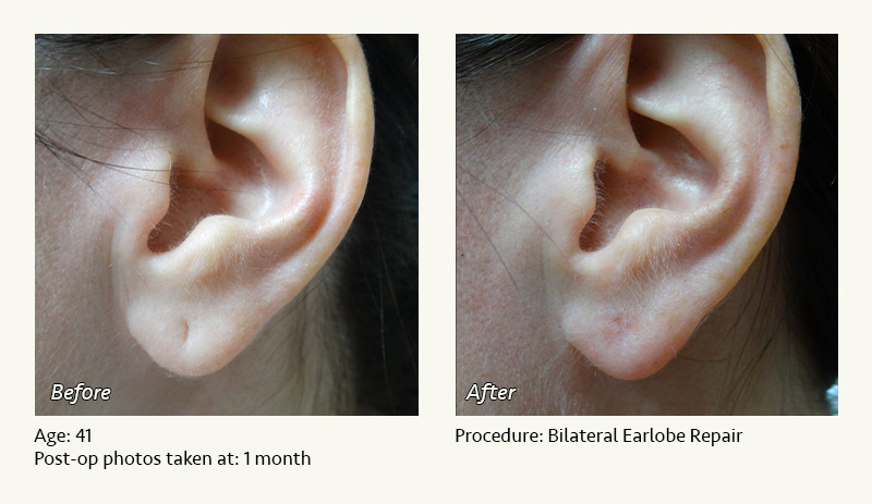 Earlobe Surgery in Plano, TX - Patient 3