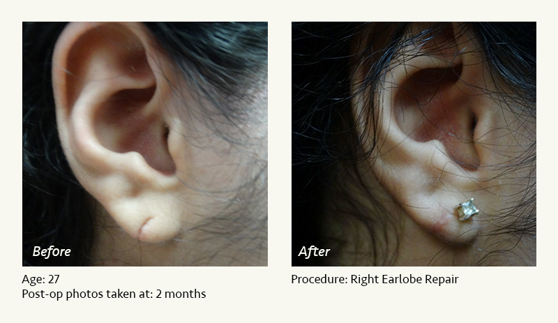Earlobe Surgery in Plano, TX - Patient 2