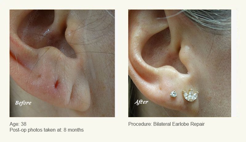 Earlobe Surgery in Plano, TX - Patient 1