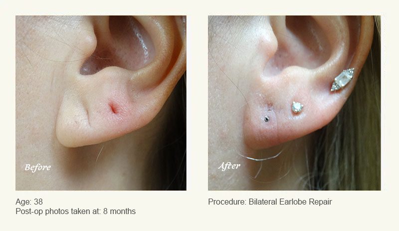 Earlobe Surgery in Plano, TX - Patient 2